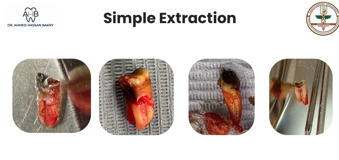 Simple Extraction